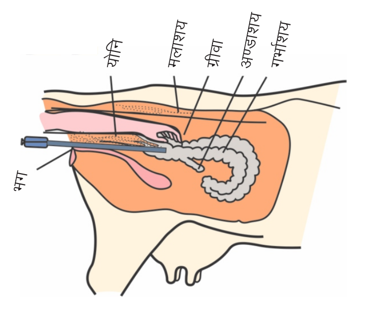 Artificial Insemination Study Note Diagram 1